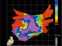 Elektrická 3D mapa srdce.
