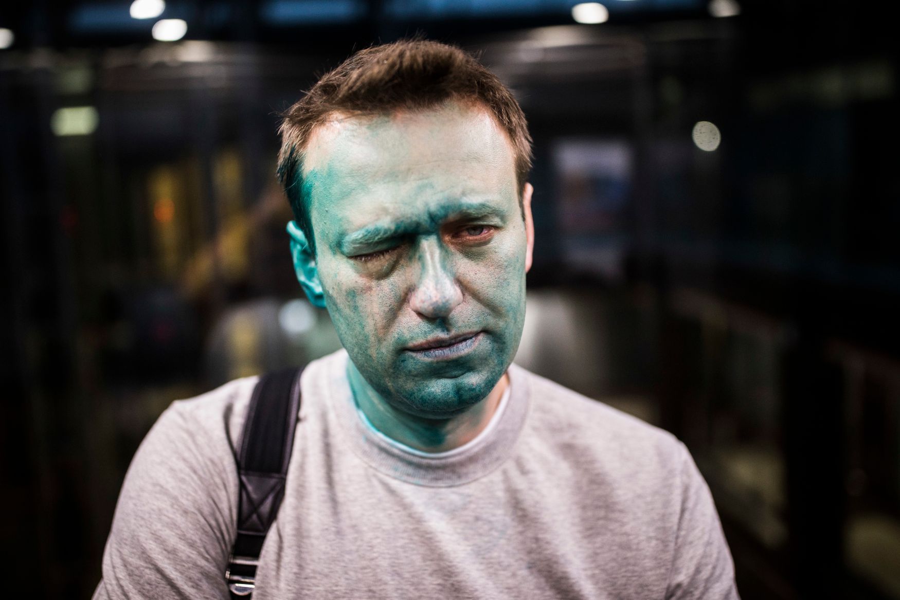 Alexej Navalnyj po útoku chemickou látkou