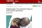 Afghánští lékaři odoperovali dívce druhou hlavu