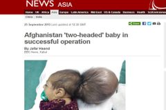 Afghánští lékaři odoperovali dívce druhou hlavu
