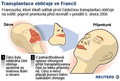 Transplantace tváře ve Francii
