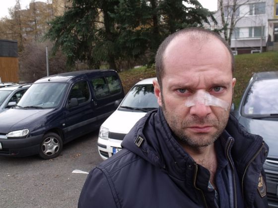 Náměstek Pavel Beran po rvačce s vojenským policistou.