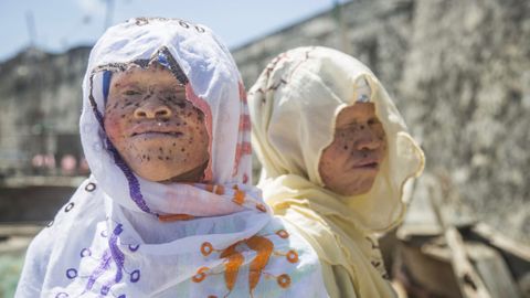 Albíni v Ghaně: Zabíjí je nenávist i rakovina kůže. Češi vymysleli, jak jim pomoci