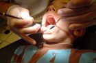 Zubaři: Děti chodí častěji na prohlídky, mají ale hodně kazů