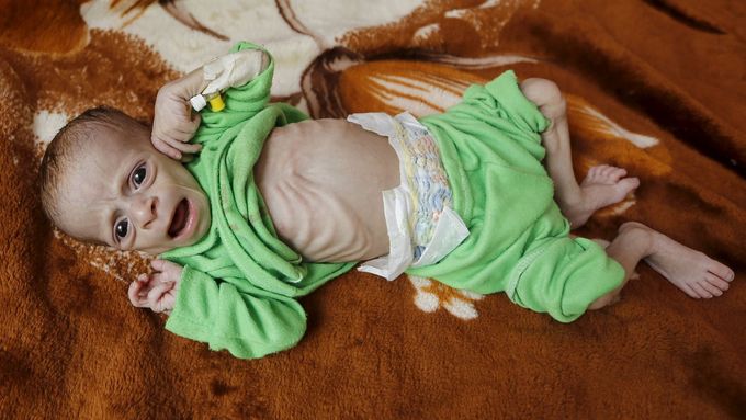 Podvyživené dítě v Jemenu.