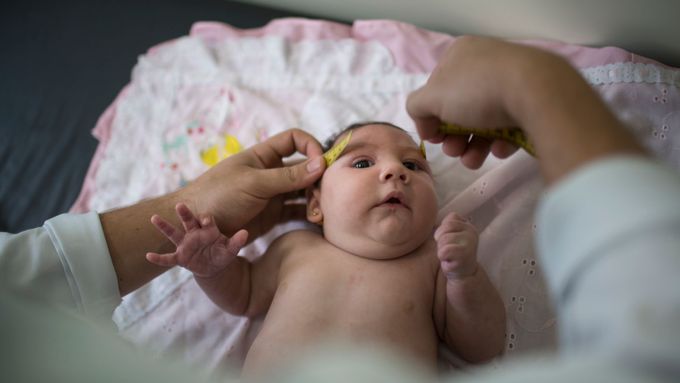 Mikrocefalie u dítěte, jehož matka se nakazila virem zika.