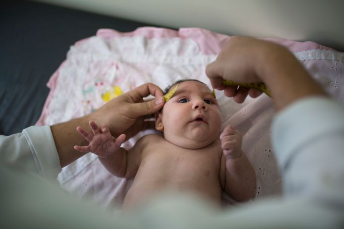 Luiza se narodila v Brazílii s poruchou zvanou mikrocefalie. Nemoc souvisí s nakažením její matky virem Zika po komářím kousnutí.